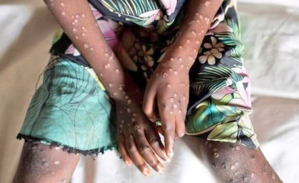 Mpox en Côte d'Ivoire © Crédit photo DR