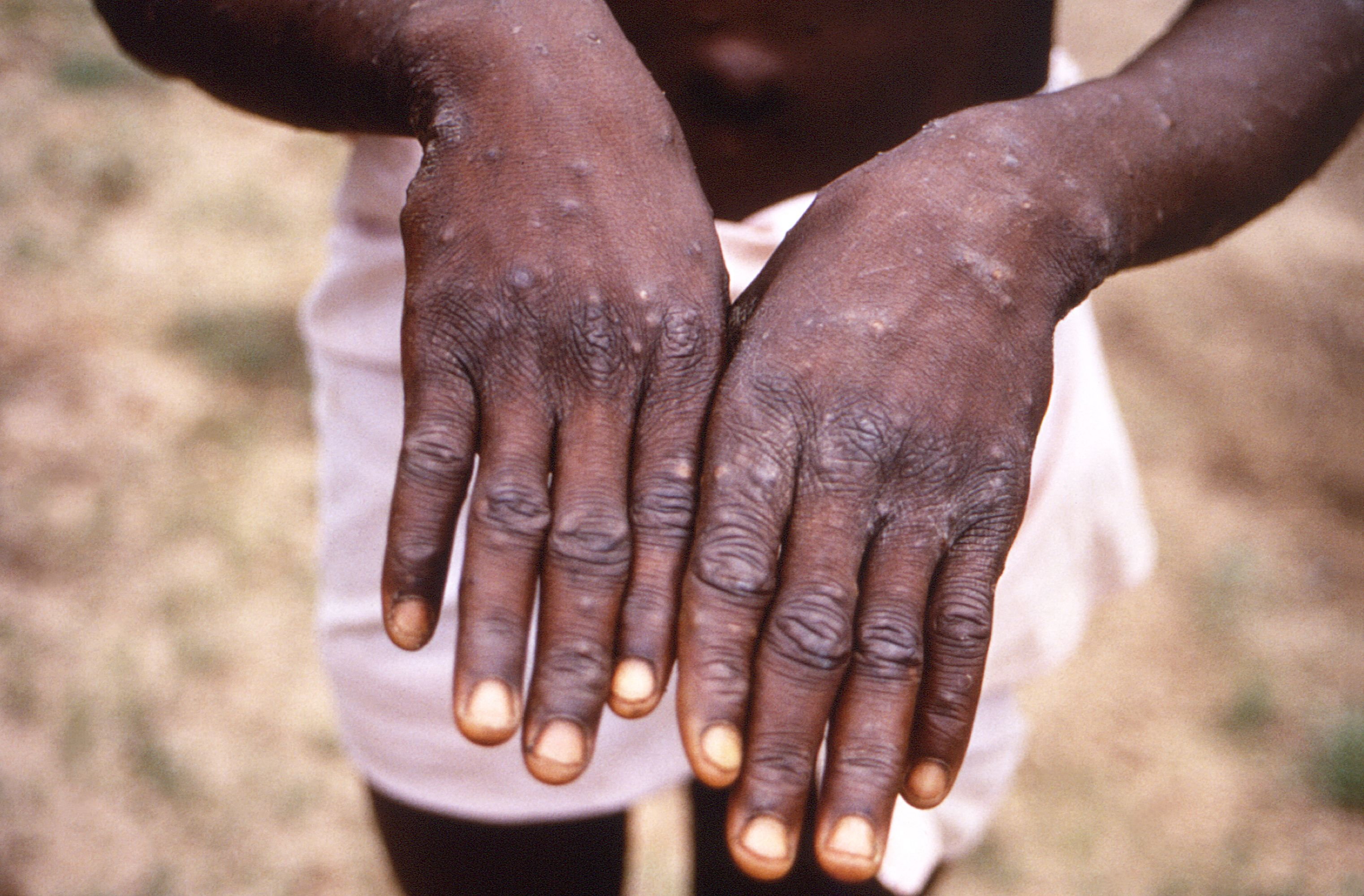 La variole du singe ou le Mpox © Crédit photo DR