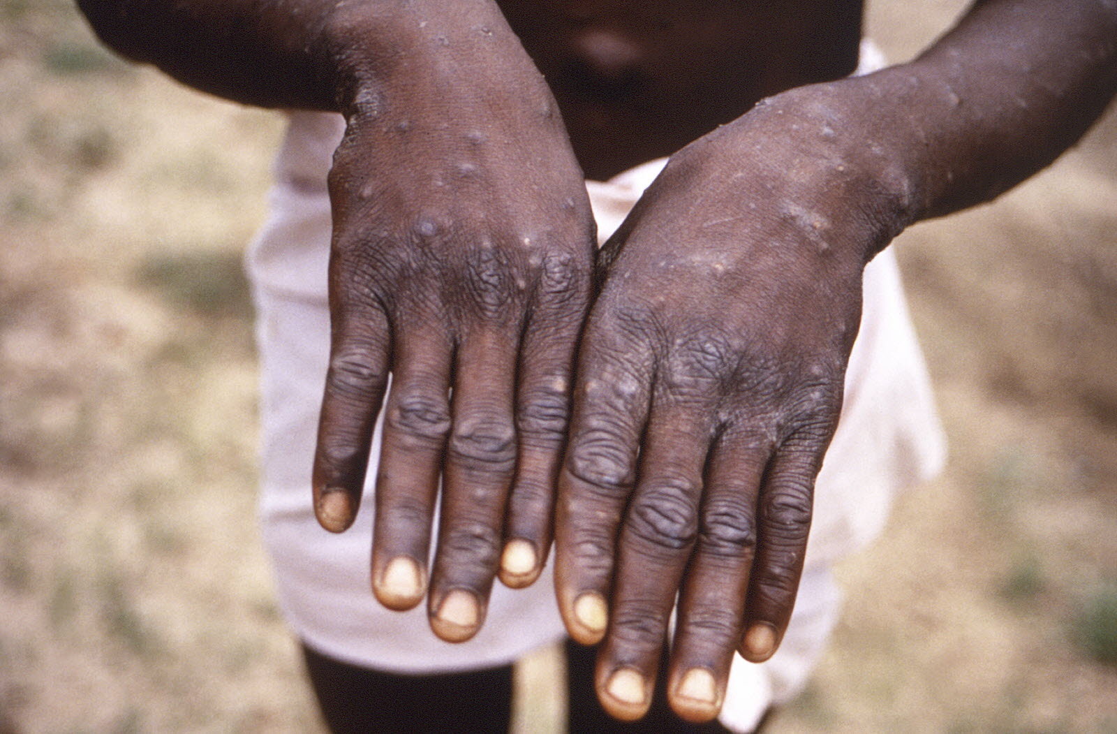 Mpox - Variole du singe à Sakassou © Crédit photo DR