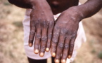 La variole du singe : 5 choses à savoir sur le Mpox