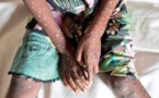 Mpox en Côte d'Ivoire : un décès, 28 cas confirmés