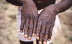 Mpox - Variole du singe à Sakassou : 4 cas confirmés